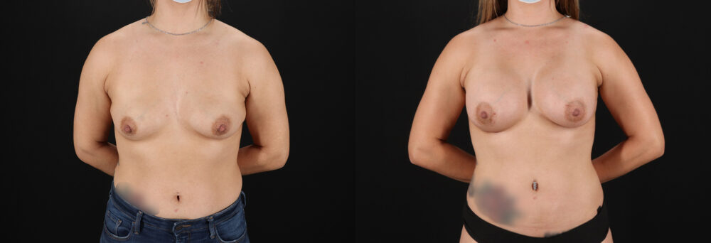 Breast Augmentation case #6408