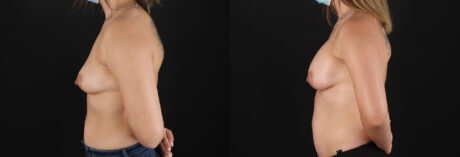 Breast Augmentation case #6408