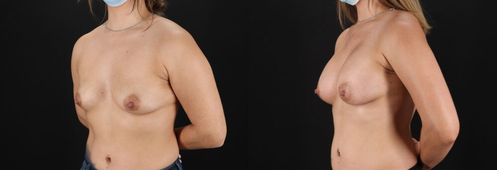 Breast Augmentation case #6408