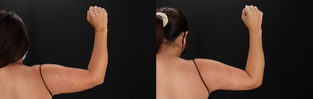 Tummy Tuck case #7470