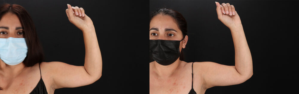 Tummy Tuck case #7470