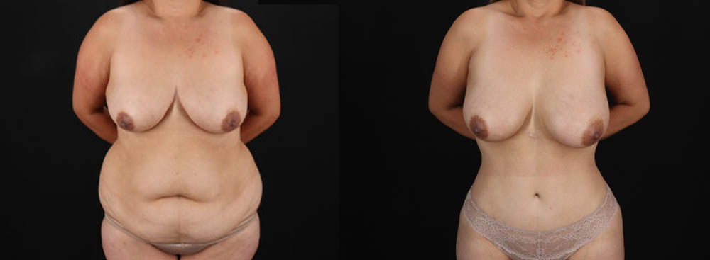 Tummy Tuck case #7470