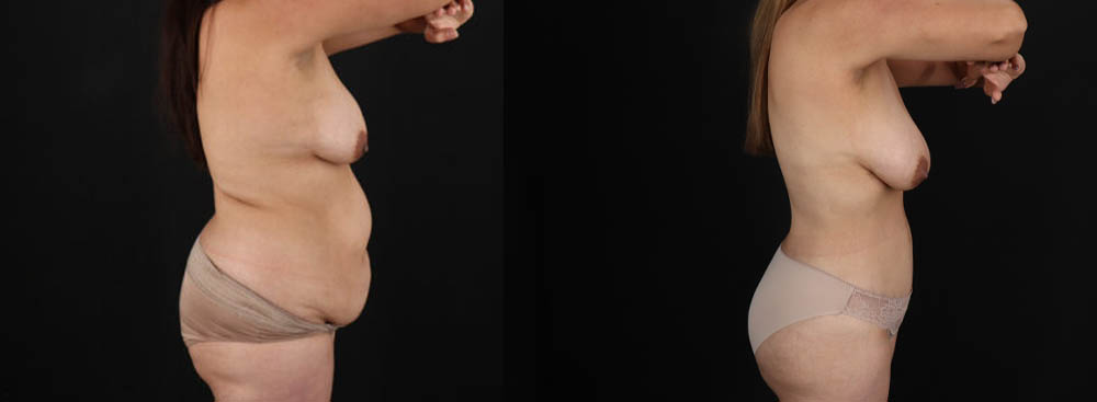 Tummy Tuck case #7470