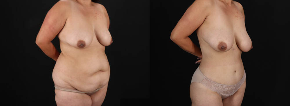 Tummy Tuck case #7470
