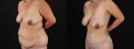 Tummy Tuck case #7470