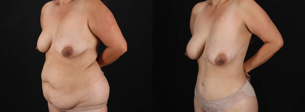 Tummy Tuck case #7470