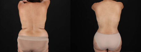 Tummy Tuck case #7470