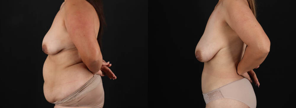 Tummy Tuck case #7470