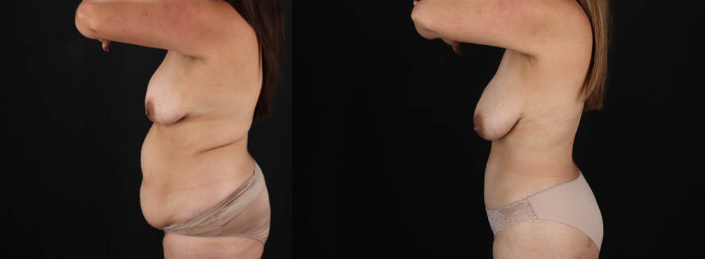 Tummy Tuck case #7470