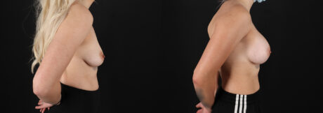 Breast Augmentation case #6414