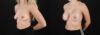 Breast Augmentation case #6414 slider thumbnail