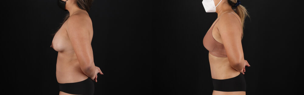 Tummy Tuck case #7471