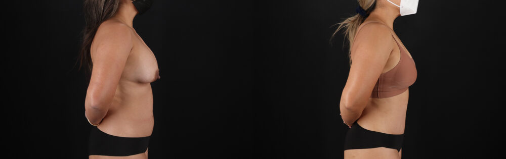 Tummy Tuck case #7471