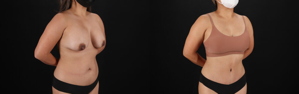 Tummy Tuck case #7471