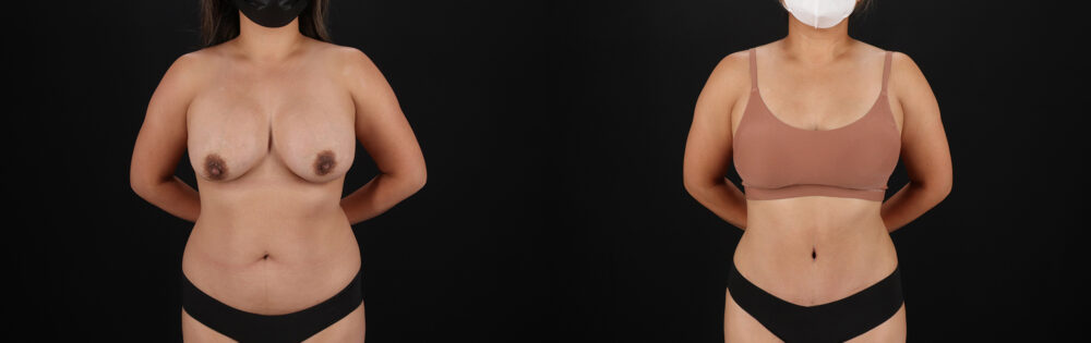 Tummy Tuck case #7471