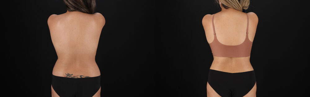 Tummy Tuck case #7471