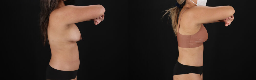 Tummy Tuck case #7471