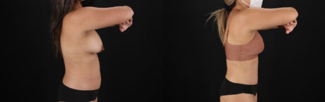 Tummy Tuck case #7471