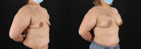 Breast Augmentation case #6420