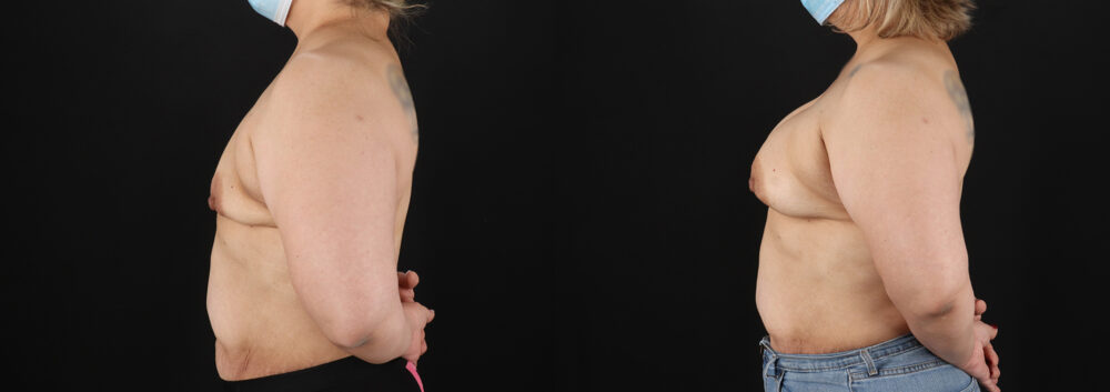 Breast Augmentation case #6420