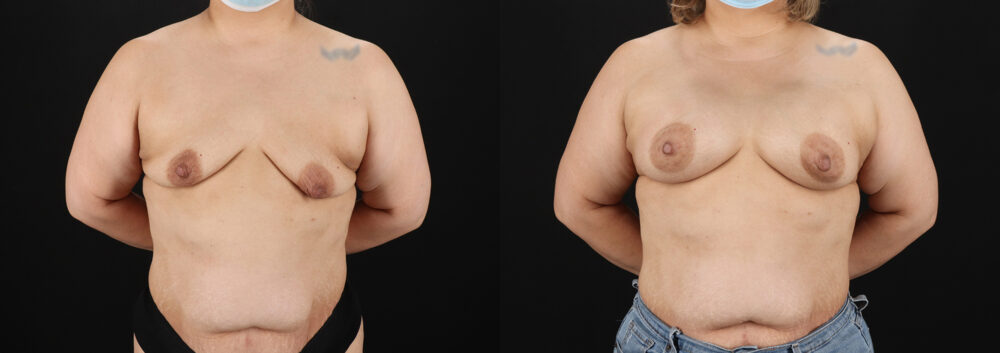 Breast Augmentation case #6420