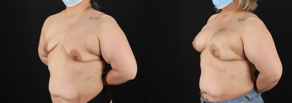 Breast Augmentation case #6420