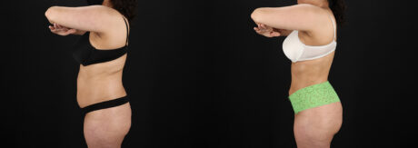 Brazilian Butt Lift case #5391