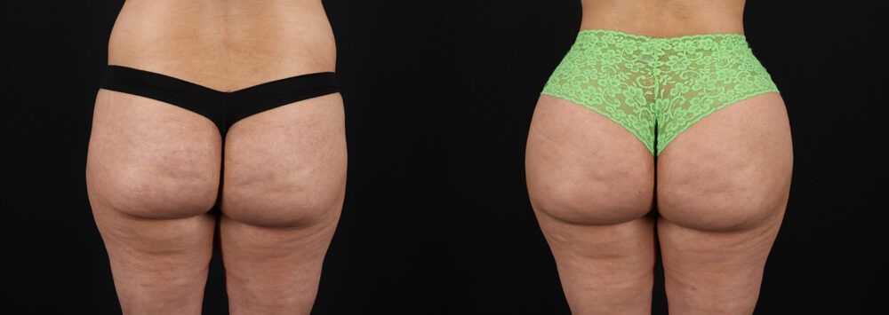 Brazilian Butt Lift case #5391