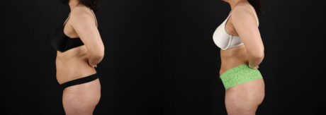 Brazilian Butt Lift case #5391