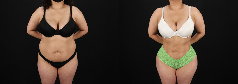 Brazilian Butt Lift case #5391