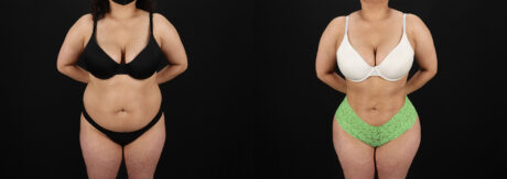 Brazilian Butt Lift case #5391