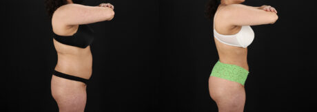 Brazilian Butt Lift case #5391