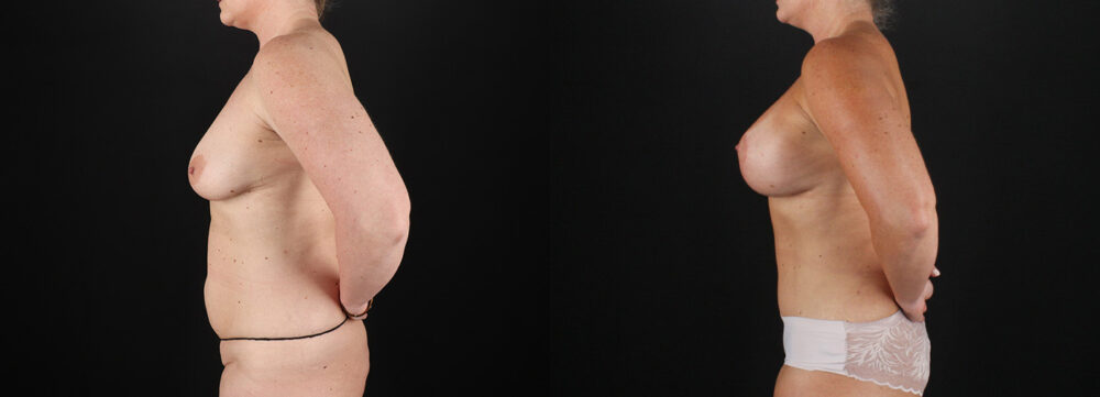 Mommy Makeover case #6684