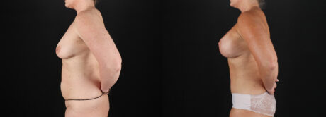 Mommy Makeover case #6684