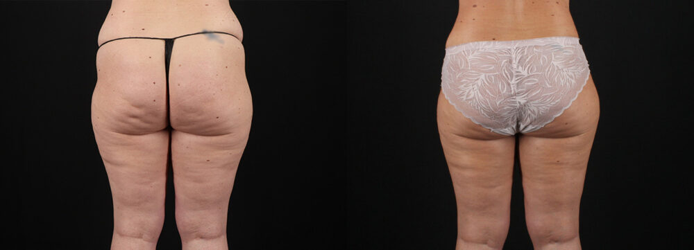 Mommy Makeover case #6684