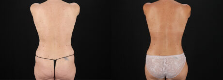 Mommy Makeover case #6684