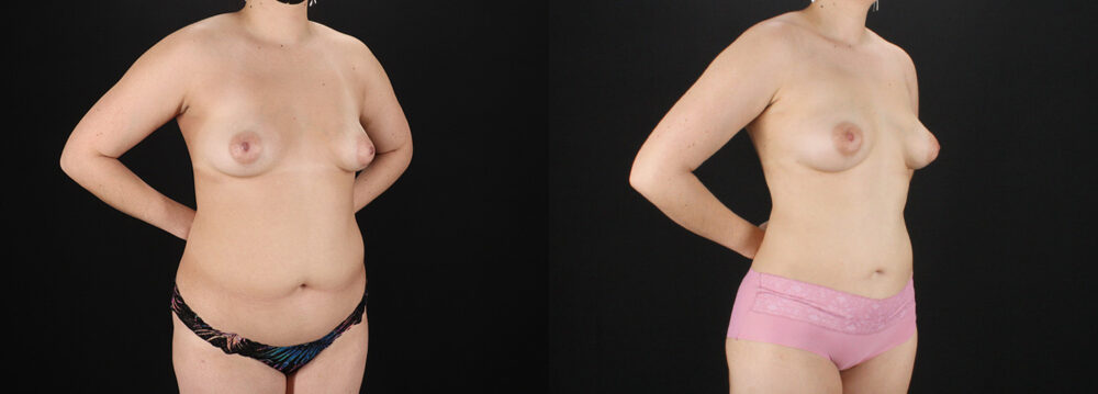 Liposuction case #6120