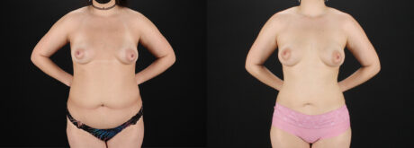 Liposuction case #6120