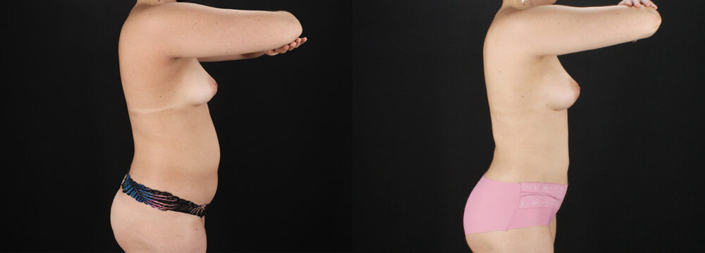 Liposuction case #6120