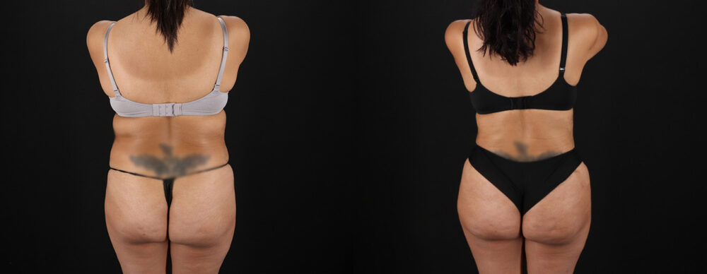 Tummy Tuck case #7472