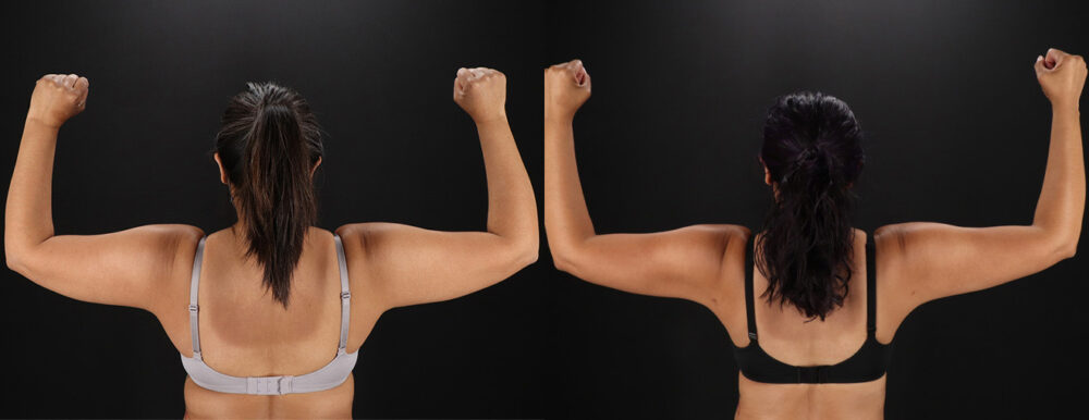 Tummy Tuck case #7472