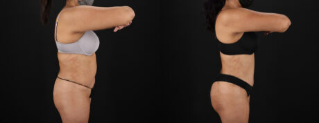 Tummy Tuck case #7472