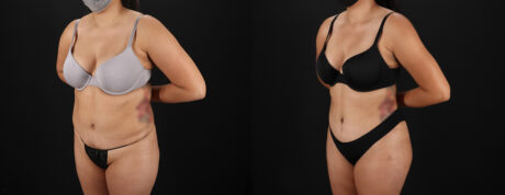 Tummy Tuck case #7472