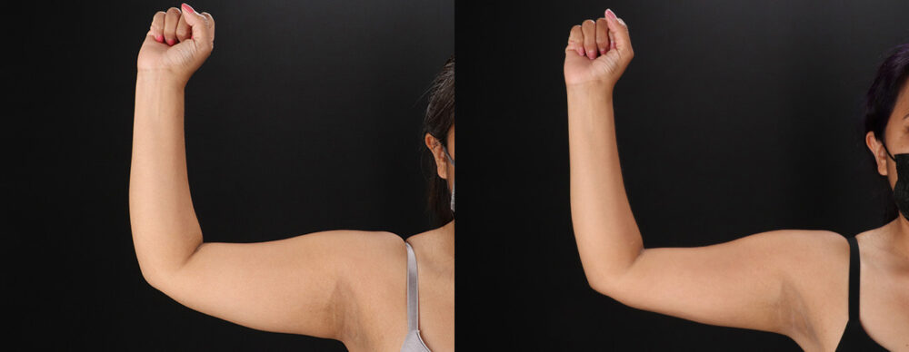 Tummy Tuck case #7472