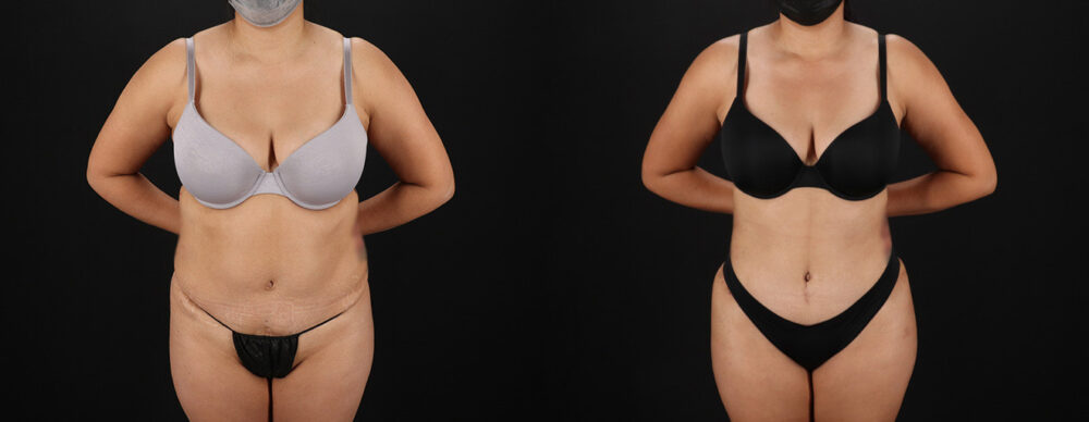 Tummy Tuck case #7472