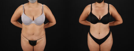 Tummy Tuck case #7472