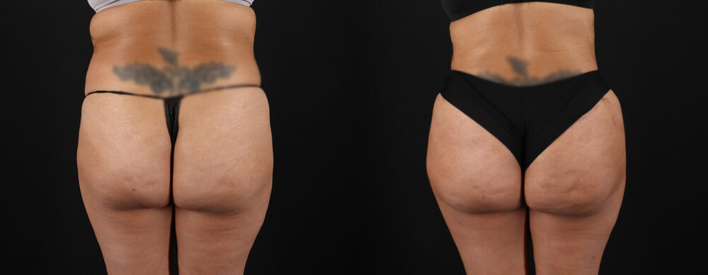 Tummy Tuck case #7472