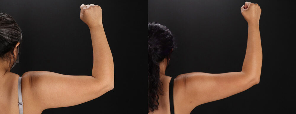 Tummy Tuck case #7472