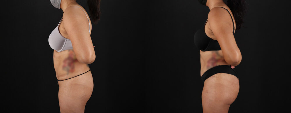 Tummy Tuck case #7472