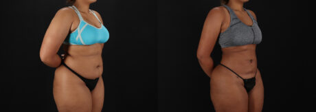 Brazilian Butt Lift case #5513